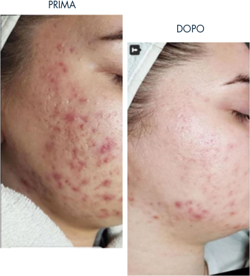 Lo sai che esistono varie tipologie di pelle grassa? 3 exuviance test creme