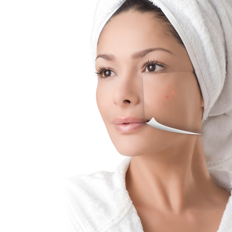 peeling chimico